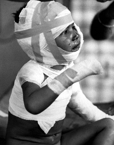 Válka ve Vietnamu (1964 - 1975). Dítě zraněné při náletu