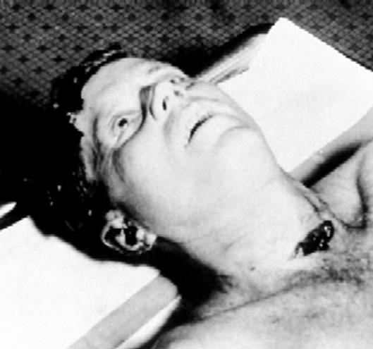 Fotografie hlavy prezidenta Kennedyho pořízená během pitvy v nemocnici Bethesda Naval Hospital